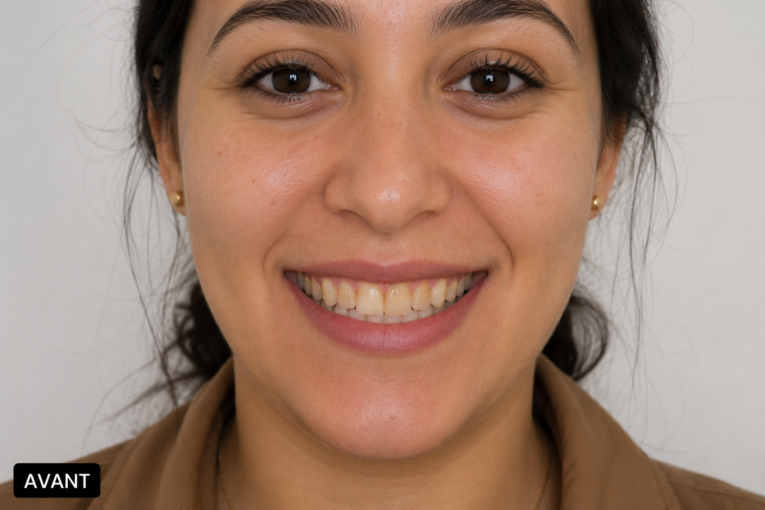 Avant éclaircissement du sourire